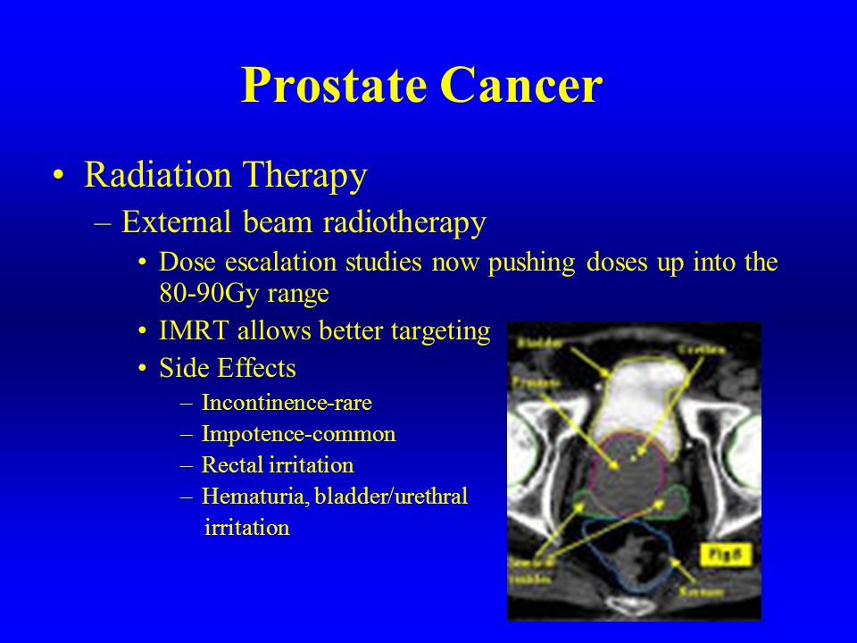 What are the side effects of prostate radiation therapy